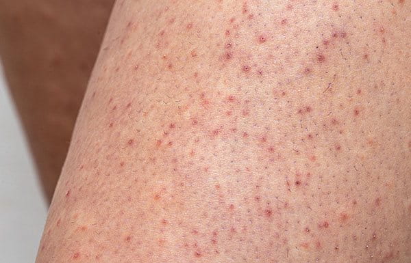 mujer cuidando su piel para evitar queratosis pilaris
