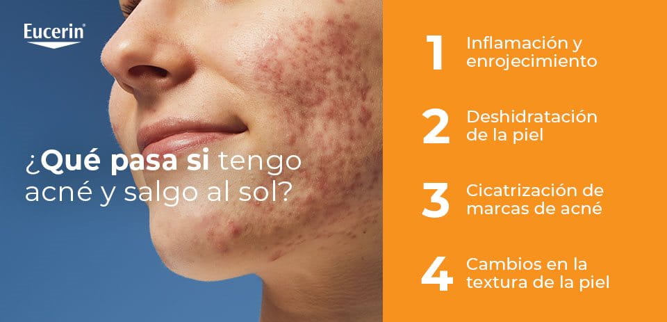 ¿Qué pasa si tengo acné y salgo al sol?