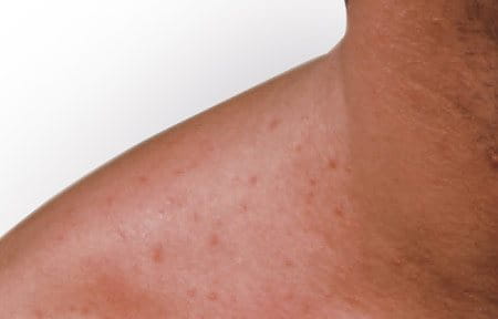 acne de Maiorca