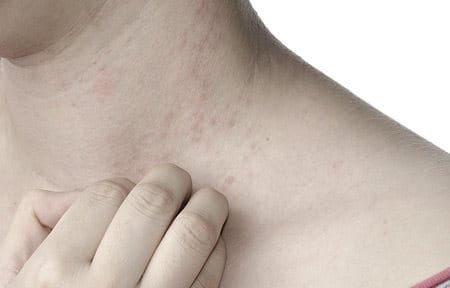 Itchy neck