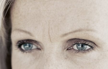 Forehead lines